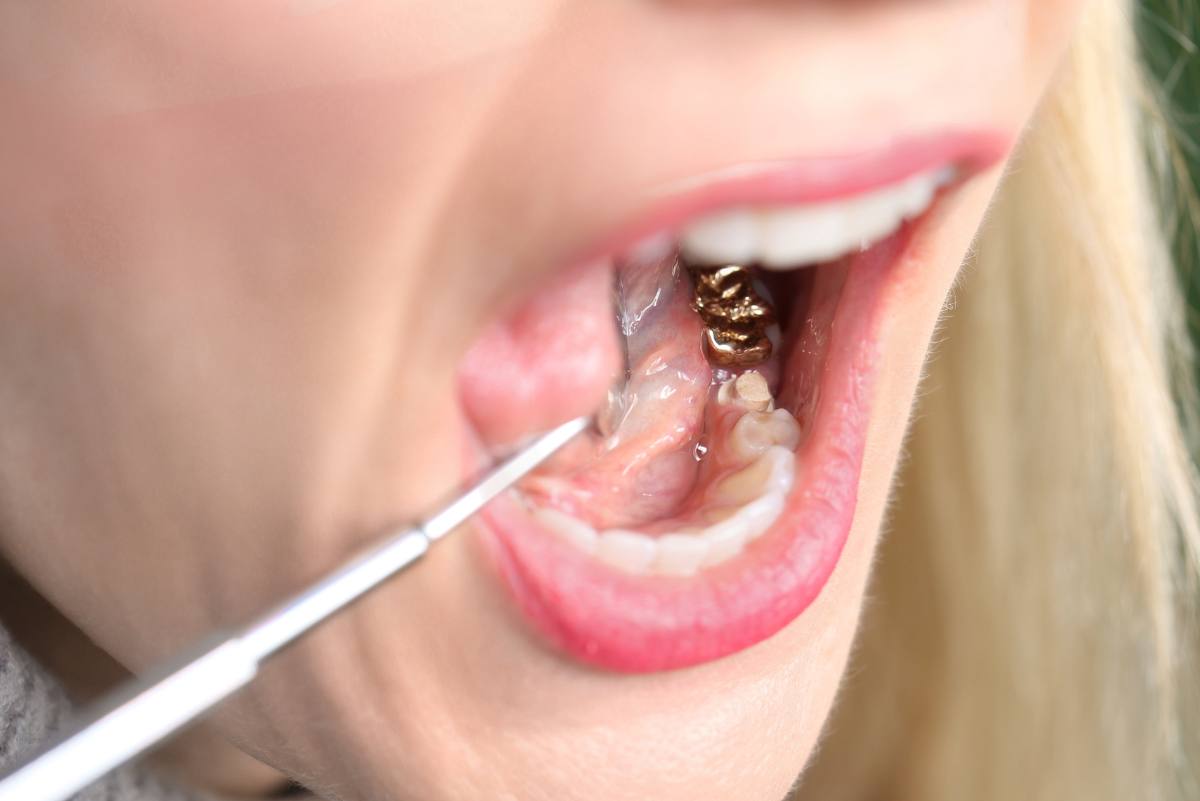 Goldkronen für den Zahn sind besonders gut verträglich und halten lange.